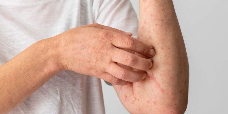 Nezvyčajné alergie, o ktorých ste možno nepočuli